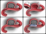 Ladvic - Medical illustration - Aneurysm Coiling Complications