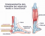 lesiones-del-tendon-de-aquiles | ICONICA Servicios Médicos