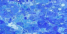 Azul de Toluidina É Usado Como Método de Diagnóstico