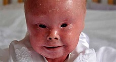 Harlequin Ichthyosis: Photos And Stories Of The Rare Skin Disease