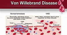 The Health Hub: Von Willebrand disease
