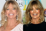 Goldie Hawn's Plastic Surgery Transformation: Before and After Photos