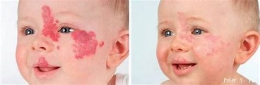 Propanolol治療嬰兒型血管瘤的使用須知 - 藝饗人生: 皮膚專科-俞佑醫師 - udn部落格