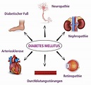 Diabetes Folgeerkrankungen | Blutzucker senken | diabetes-managen.de