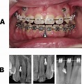 Miniscrew mechanics for molar distalization and incisor intrusion in a ...