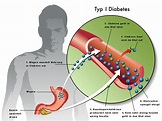 Diabetes mellitus (Zuckerkrankheit): Typen und Symptome