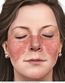 Lupus facial rash - Mayo Clinic
