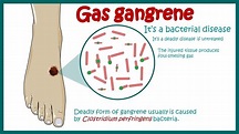 Gas Gangrene | Clostridial Myonecrosis | Symptoms and treatment of Gas ...