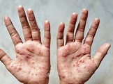 越南卫生部提出六大预防猴痘措施 | 社会 | Vietnam+ (VietnamPlus)