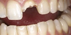 10 primeros pasos al fracturarse un diente - Clínica Dental Gramadent