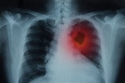 ¿Cómo se manifiesta el cáncer de pulmón? | El Diario NY