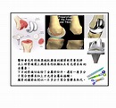 安全、有效的微創人工膝關節置換治療＠coolanews府城電子報｜PChome 個人新聞台