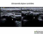 Ultrasonido dúplex carotídeo: MedlinePlus enciclopedia médica illustración