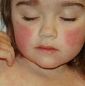 Rash on Face - Treatment, Causes, Pictures - HubPages