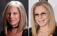 Barbra Streisand Plastic Surgery Before and After Botox Injections ...