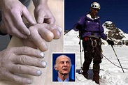 Sir Ranulph Fiennes sawed off his own fingers after becoming 'irritable ...