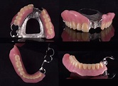 局部活動假牙案例01 - Dr. Implant 新竹光明牙醫診所