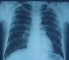 Figura Nº2. Radiografía de tórax muestra infiltrado intersticial ...