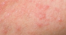 What Is Keratosis Pilaris, And Why Does It Look Like Body Acne?