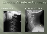 Hangman's Fracture Xray XR Cervical Spine Vertebrae Clay Shoveler's Fx ...