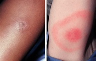 Lyme Disease Rash – 𝗗𝗜𝗔𝗚𝗡𝗢𝗦𝗜𝗦 𝟭𝟮𝟯