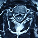 (PDF) Snake Eyes Sign in Cervical Magnetic Resonance Imaging in a ...