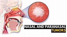 Nasal and Paranasal Tumors, Causes, Signs and Symptoms, Diagnosis and ...
