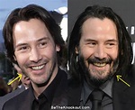 Keanu Reeves Plastic Surgery Comparison Photos