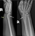 Colles fracture – Radiology Cases