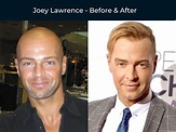 Joey Lawrence Hair Transplant: A Detailed Examination - Cosmeticium