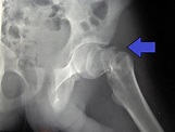 Fractura de cadera: causas y tratamiento - Camde