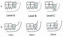 Illustrative diagram of Pell and Gregory classifications; a: Level of ...