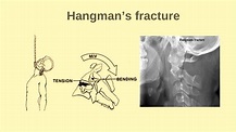 Hangman's Fracture |C2 fracture |Cervical spine fracture - YouTube