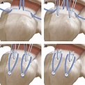 The Evolution of Suture Anchors in Arthroscopic Rotator Cuff Repair ...