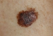 Skin Cancer: Signs, Symptoms, and Complications