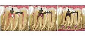 Pulpa Dental Infectada - Cuidado Dental Personalizado