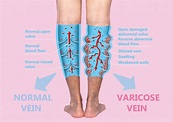 Vein Treatments - Vein Specialists of the Carolinas treat thousands yearly
