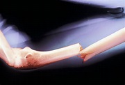 Mid-Shaft Humerus Fracture Treatment