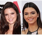 Cirugías de Kendall Jenner, fotos del antes y después - Fama