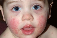 Rashes in babies and children - NHS