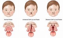 Cleft Lip and Cleft Palate | Vikram ENT Hospital