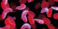 Black Americans With Sickle Cell Trait At Increased Risk Of Kidney ...