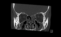Trapdoor fracture | Radiology Reference Article | Radiopaedia.org