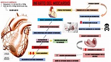 Infarto Agudo del Miocardio | Medimind | uDocz