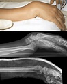 Moore fracture • LITFL Medical Blog • Medical Eponym Library