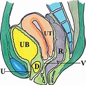 Imaging of Female Urethral Diverticulum: An Update | RadioGraphics