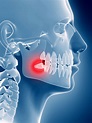 Wisdom Teeth Oral Surgenons » Minneapolis Oral Surgeons » Minnesota ...