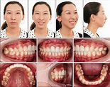 深咬、暴牙與長臉型的矯正，利用骨釘達到改善臉型的效果 | 茉莉牙醫