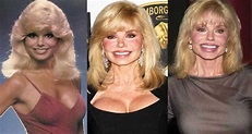Loni Anderson Plastic Surgery Before and After Pictures 2021