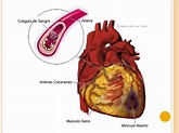 Infarto agudo de miocardio